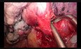 Wideotorakoskopowa anatomiczna trisegmentektomia z jednego cięcia