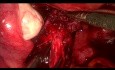 Usunięcie endometriozy z nerwu podbrzusznego