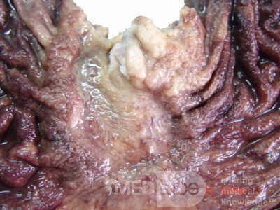 Gruczolakorak wpustu i dna żołądka z komórkami sygnetowatymi (15 z 25)