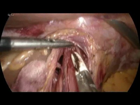 Laparoskopowa kardiomiotomia sposobem Hellera