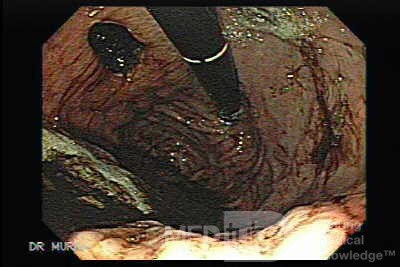 Rak żołądka - duży wrzód ściany tylnej dna żołądka