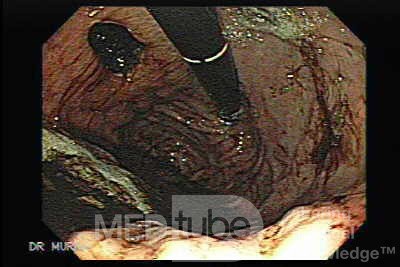 Rak żołądka - duży wrzód ściany tylnej dna żołądka