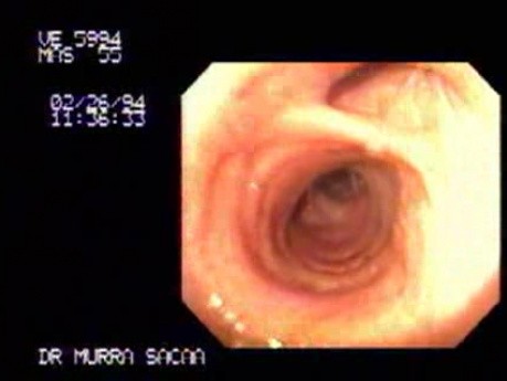 Endoskopowa ocena rozdwojenia tchawicy