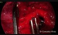Lobektomia górna lewa wykonana metodą Uniportal VATS bez intubacji