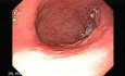 Rak żołądka - obraz endoskopowy