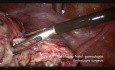 Usunięcie torbieli endometrialnej jajnika dla rezydentów (operacja dydaktyczna)