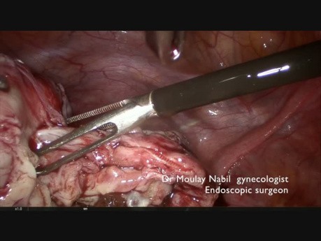 Usunięcie torbieli endometrialnej jajnika dla rezydentów (operacja dydaktyczna)