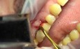 Ekstrakcja zęba i natychmiastowa implantacja – krok po kroku