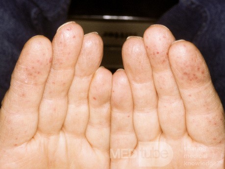 Koniuszki palców w chorobie Rendu-Oslera-Webera