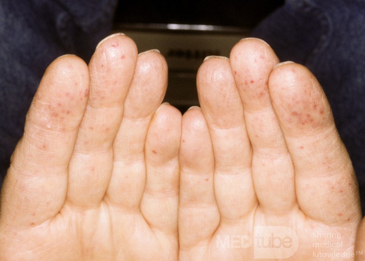 Koniuszki palców w chorobie Rendu-Oslera-Webera