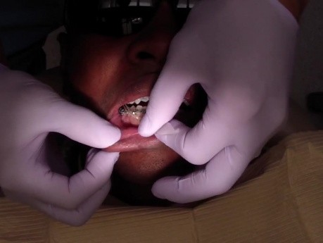 Przypadek Ortodontyczny #3 - Mezjalizacja Tylnego Segmentu Szczęki - Wyciągi Elastyczne klasy III
