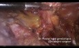 Radykalna histerektomia i transpozycja jajników przy raku szyjki macicy