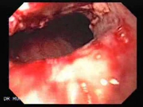 Synchroniczny rak żołądka i przełyku - wizualizacja nacieku nowotworowego w środkowej części przełyku