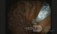Endoskopowa hepaticogastrostomia pod kontrolą EUS [5/10]