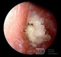 Przewlekłe zapalenie ucha zewnętrznego z dużą warstwą białej keratyny