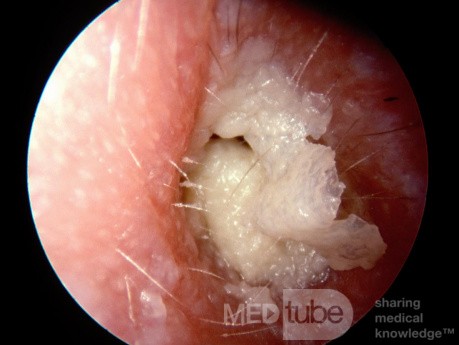 Przewlekłe zapalenie ucha zewnętrznego z dużą warstwą białej keratyny