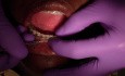 Założenie łańcuszka ortodontycznego - Moje zmagania - Twój zysk