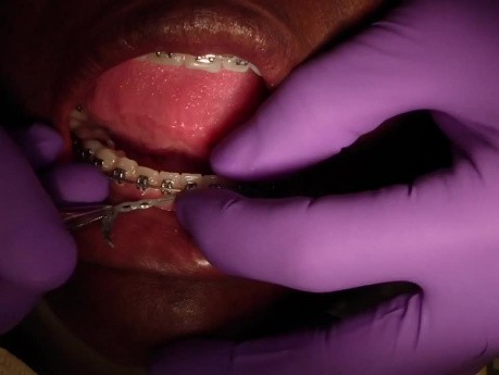 Założenie łańcuszka ortodontycznego - Moje zmagania - Twój zysk