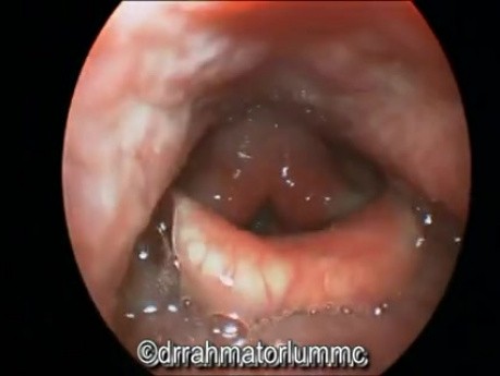 Refluks gardłowo-krtaniowy: typowy wygląd endoskopowy krtani