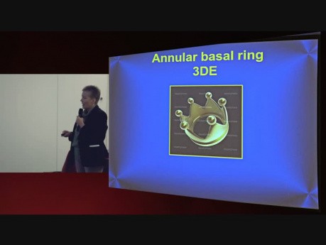 Nowe metody echokardiografii 3D do doboru rozmiaru pierścienia w TAVI, zalety i wady