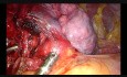 Wideotorakoskopowa lobektomia środkowa z jednego cięcia podmostkowego