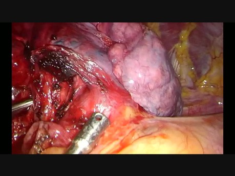 Wideotorakoskopowa lobektomia środkowa z jednego cięcia podmostkowego