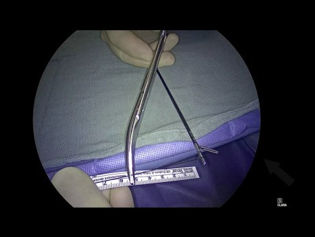 Geometry Fundoplication App - instruktaż, rozdział 06 - Tworzenie linijki chirurgicznej 