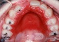 Drożdżyca na podniebieniu twardym w wyniku protezy zębowej