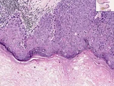 Carcinoma in situ - Histopatologia penisa