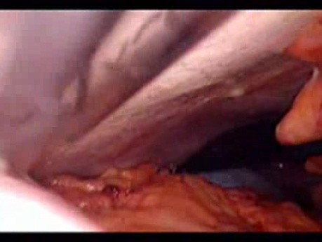 Perforacja okrężnicy z zapaleniem otrzewnej - laparoskopia (43 z 46)