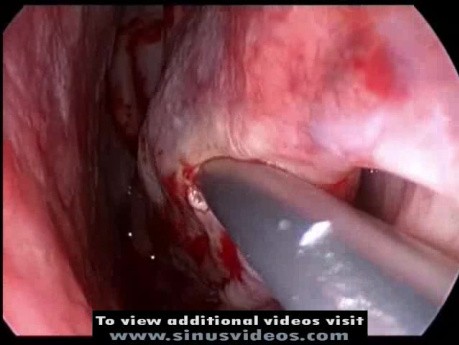 Resekcja małżowiny nosowej dolnej (konchoplastyka)