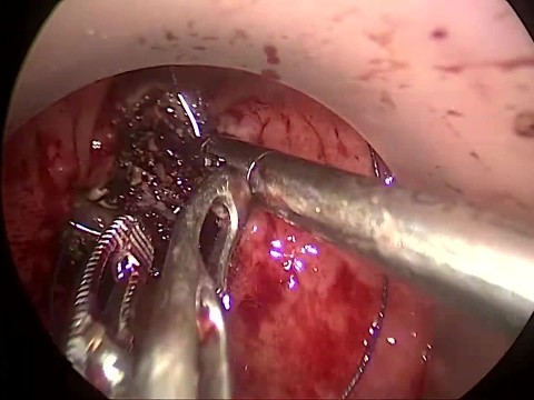 rectovesical fistula