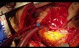 Tłuszczakomięsak w obrębie tętnic płucnych