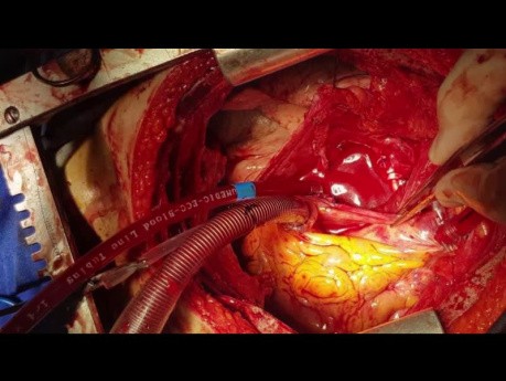 Tłuszczakomięsak w obrębie tętnic płucnych