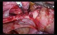 Endometrioza - Laparoskopowe wyłuszczenie guza endometrialnego 