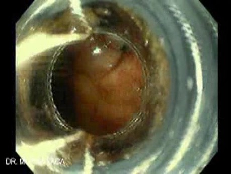 Krwawienie z górnej części przewodu pokarmowego z powodu żylaków przełyku - żylak ze zmianami nekrotycznymi