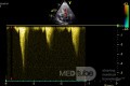 Kardiomiopatia przerostowa z zawężaniem drogi odpływu z lewej komory - widmo Dopplera ciągłego 