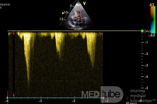 Kardiomiopatia przerostowa z zawężaniem drogi odpływu z lewej komory - widmo Dopplera ciągłego 