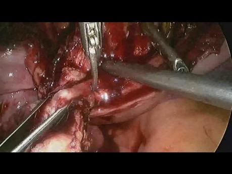 Laparoskopowa naprawa isthmocele po 2 wcześniejszych cięciach cesarskich w dolnym odcinku macicy