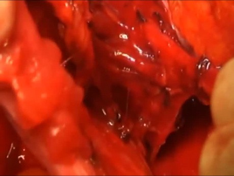 Histerektomia radykalna - resekcja więzadła pęcherzowo-macicznego
