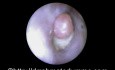 Czyszczenie ucha: pozostały wacik kosmetyczny w kanale słuchowym
