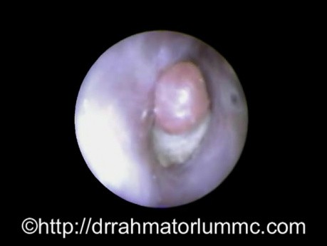 Czyszczenie ucha: pozostały wacik kosmetyczny w kanale słuchowym