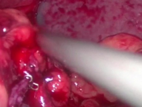 Przecięcie zgłębnika żołądkowego podczas resekcji rękawowej żołądka