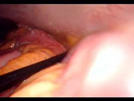 Perforacja okrężnicy z zapaleniem otrzewnej - laparoskopia (33 z 46)