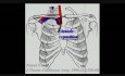 Wykorzystanie przedniego dostępu do klatki piersiowej przez szyję w zabiegu usunięcia guza płuca naciekającego górny otwór klatki piersiowej oraz obojczyk. 