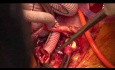 Całkowita wymiana łuku aorty za pomocą metody typu elephant trunk