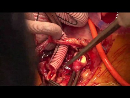Całkowita wymiana łuku aorty za pomocą metody typu elephant trunk