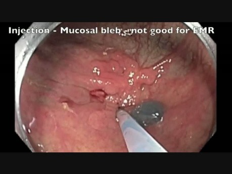 Endoskopowa mukozektomia - okrężnica - cz. B