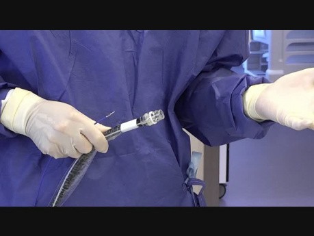 Endoskopowa resekcja gruczolaka odbytnicy z użyciem FTRD