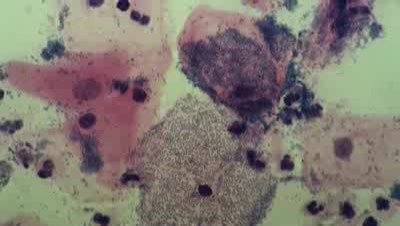 Zapalenie pochwy - Komórki jeżowe